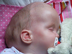 Side view of macrocephaly with hydrocephalus and cysts