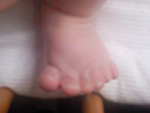 Left foot with extra digit (2nd big toe)