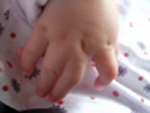 Right hand with full syndactyly